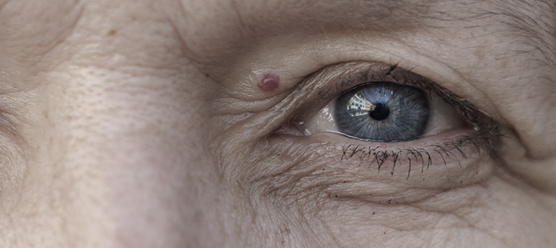 Frau mit Blutschwämmchen über dem Auge